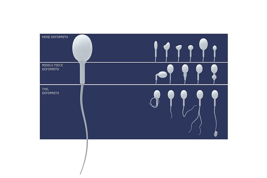 Sperm deformity classification, illustration