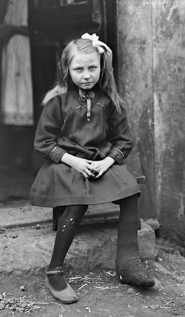 Child with tuberculosis, France, 1918