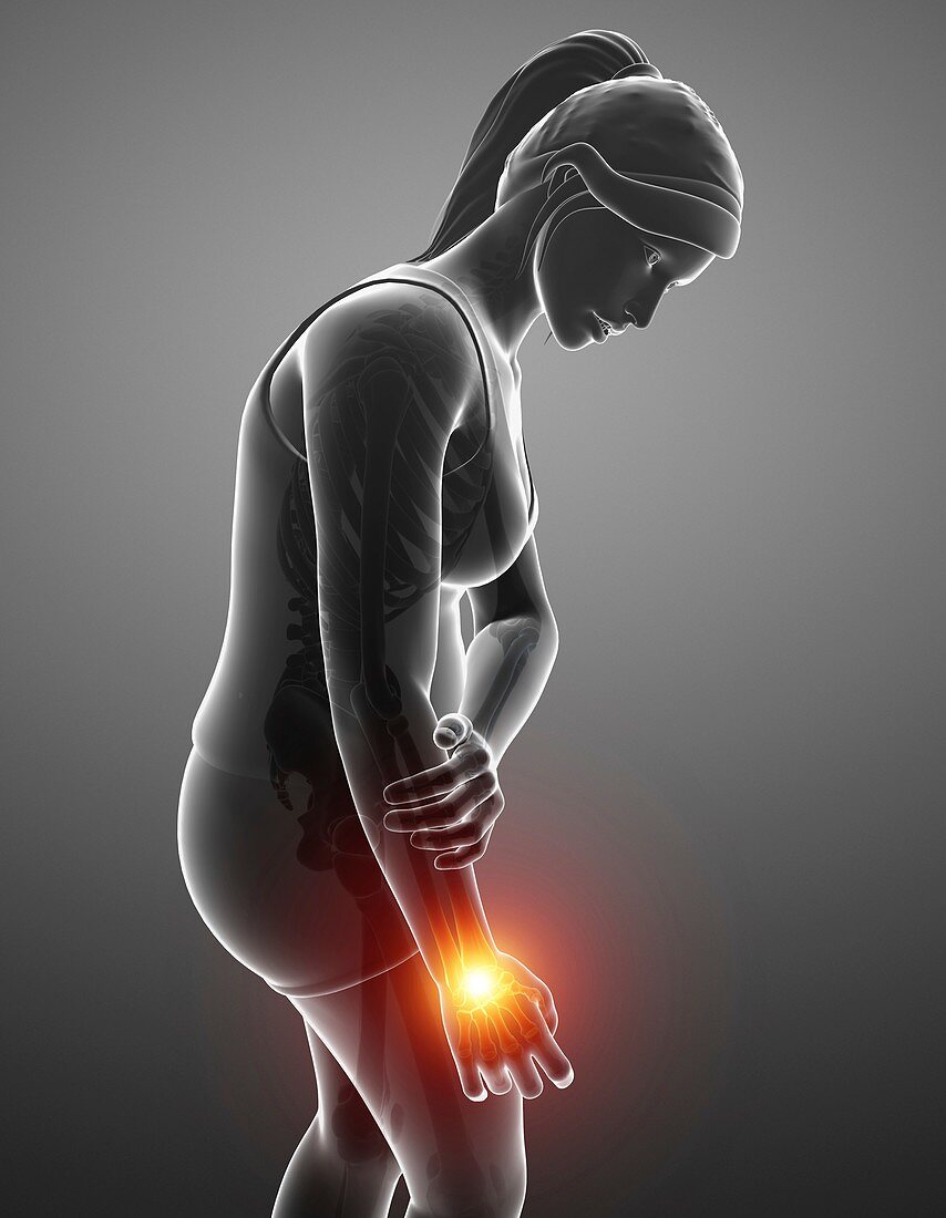 Woman with wrist pain, illustration