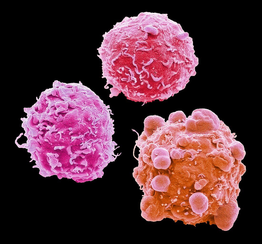 Colorectal cancer cells, SEM