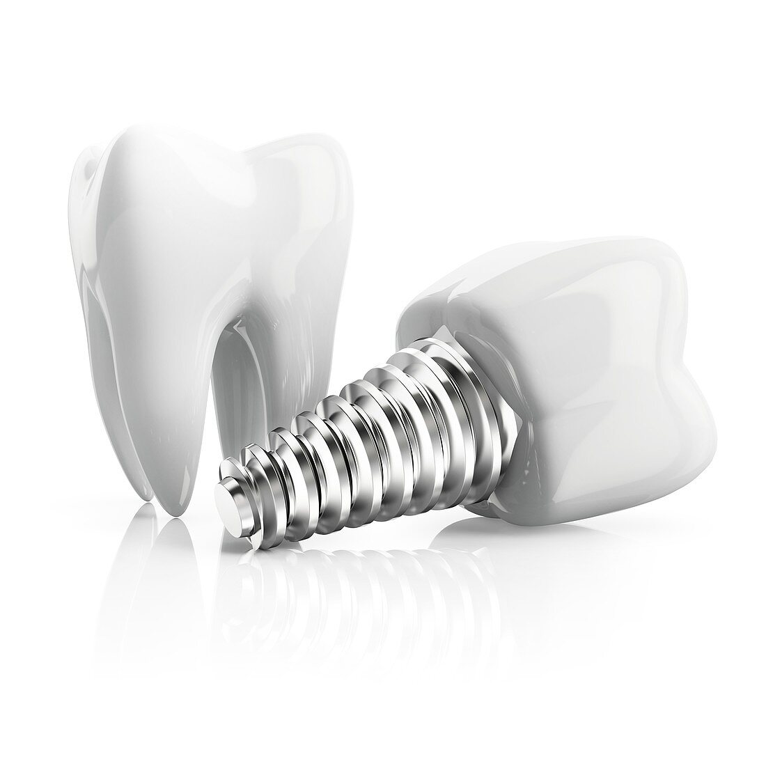 Tooth implant, illustration