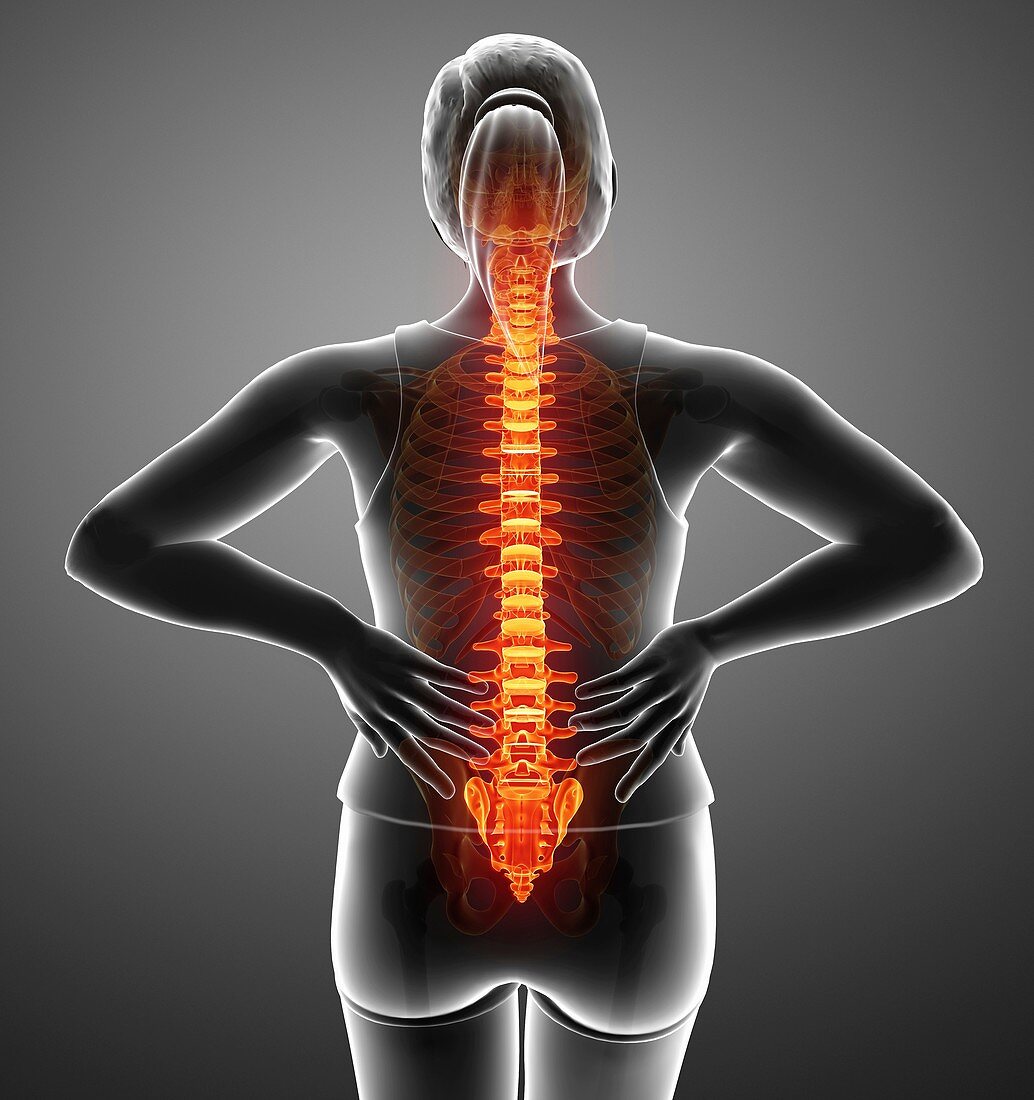 Woman with back pain, illustration