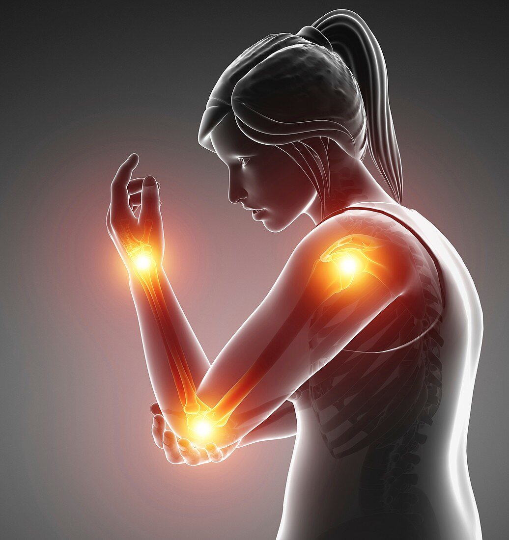 Woman with arm pain, illustration