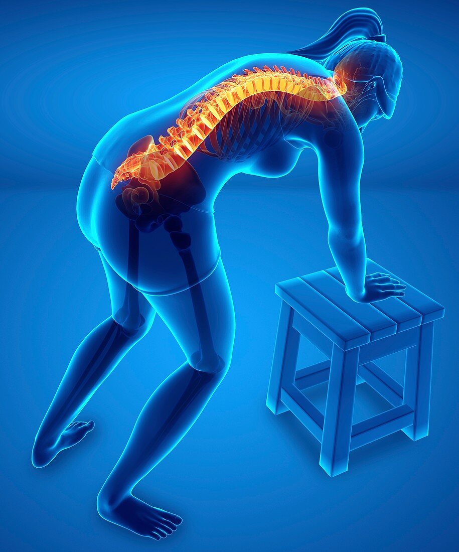 Woman with back pain, illustration