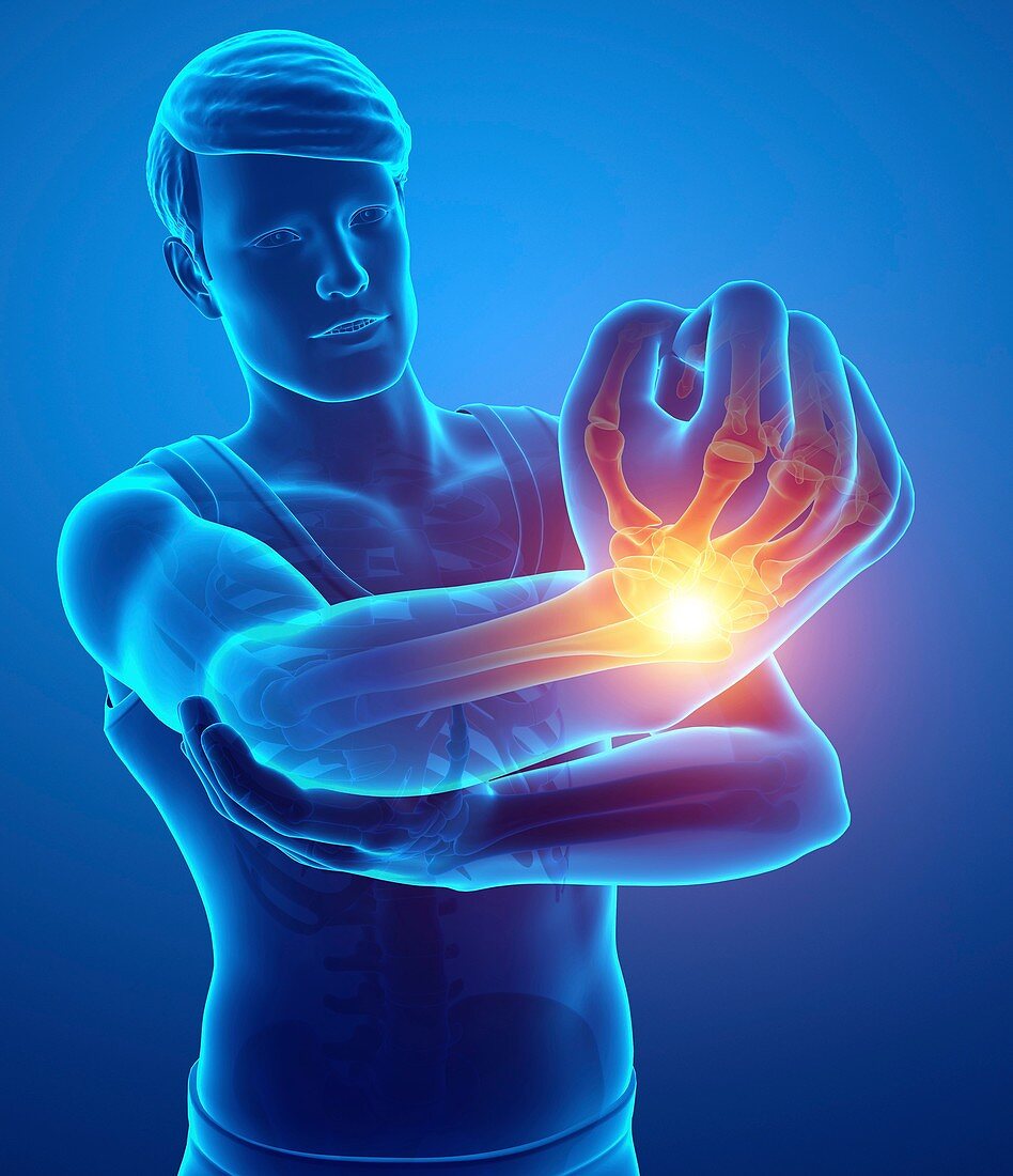 Man with wrist pain, illustration