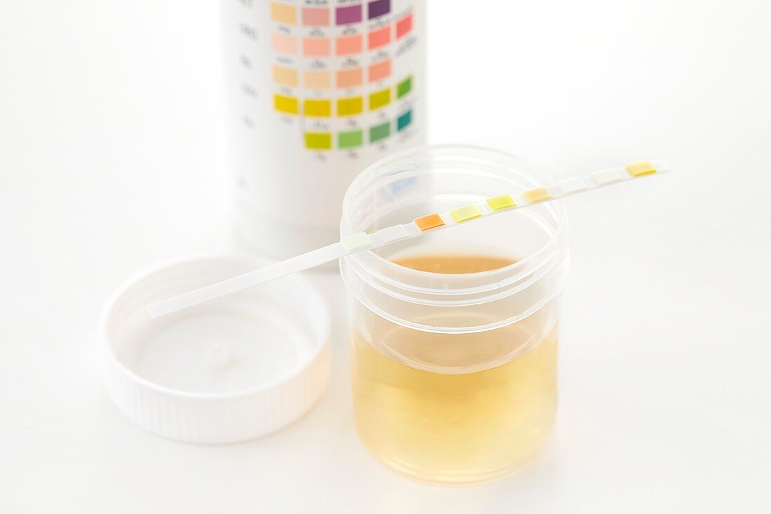 Urine sample for analysis and test strip
