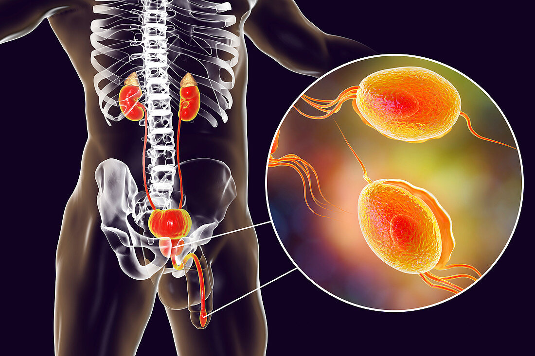 Trichomoniasis, illustration