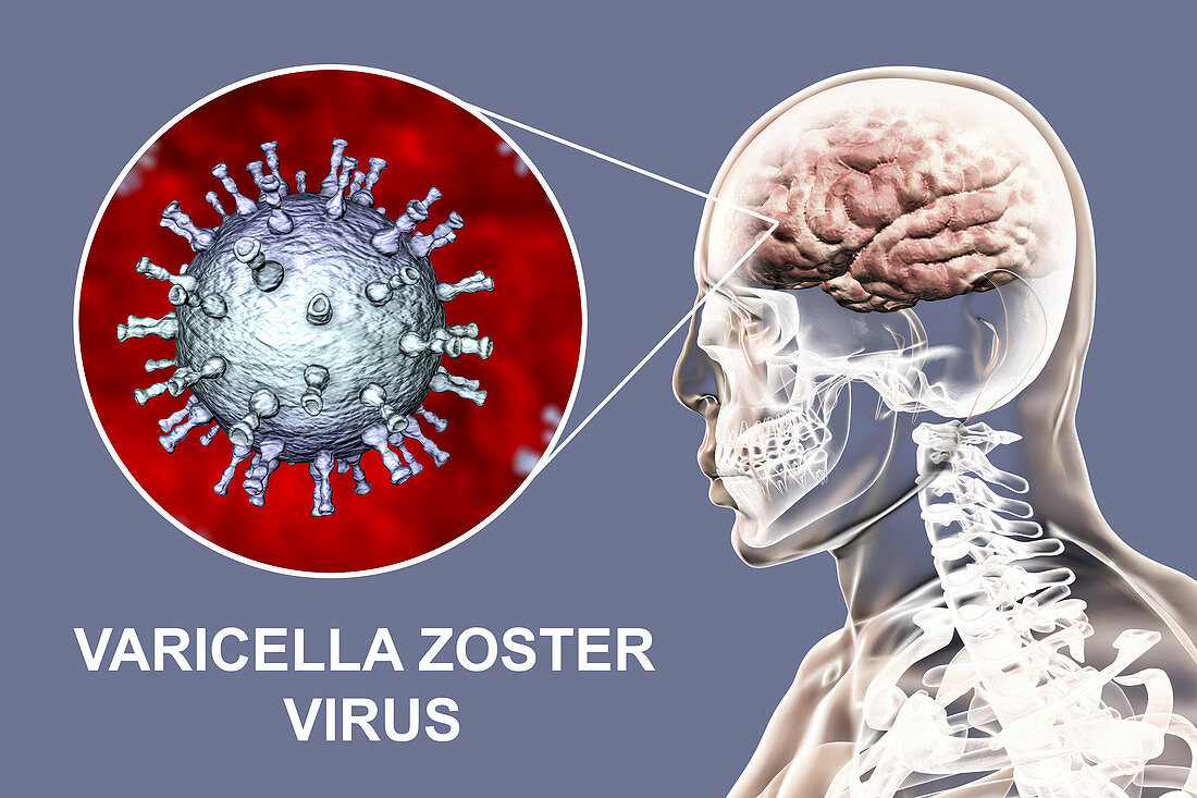 Encephalitis caused by varicella zoster virus, illustration