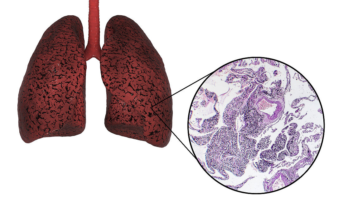 Smoker's lungs, illustration and light micrograph