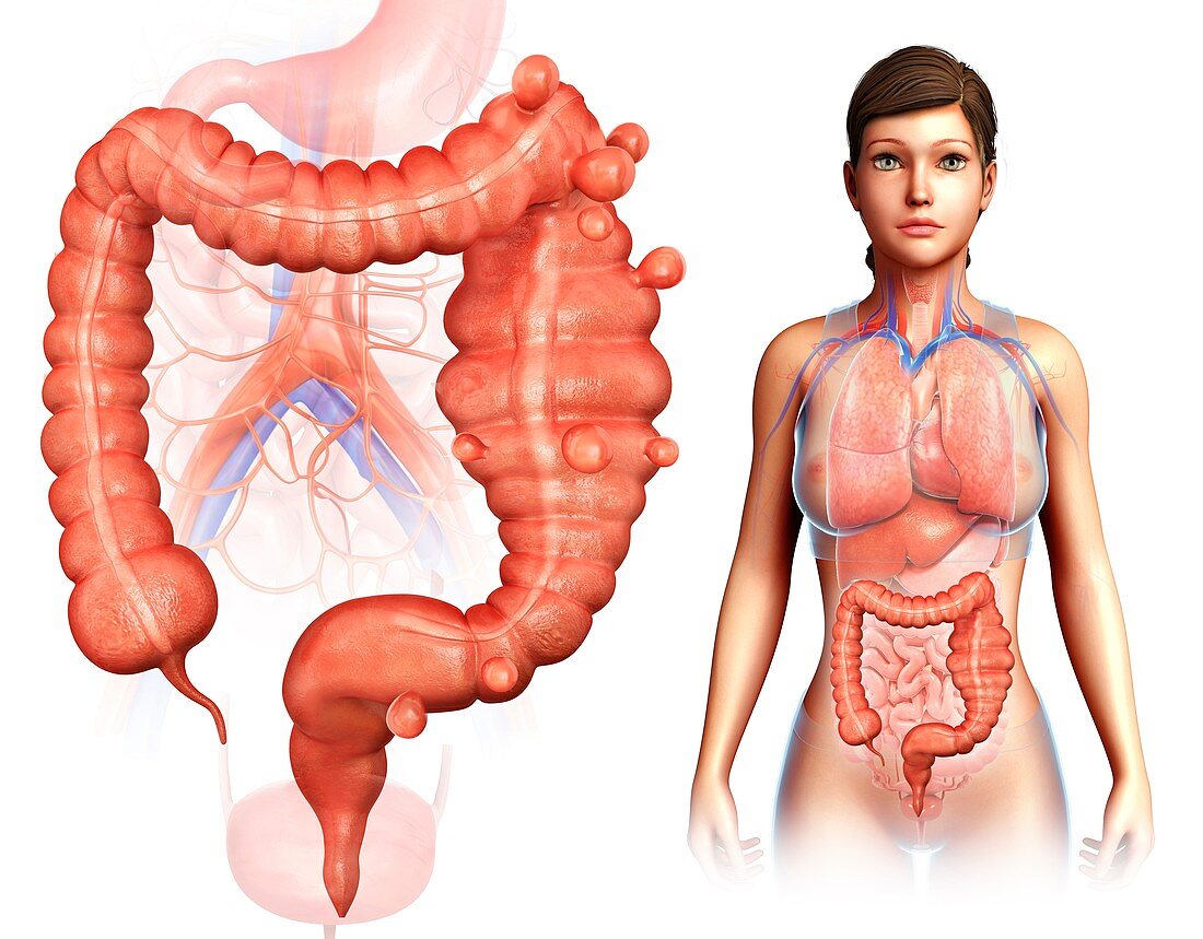 Diverticulosis and megacolon, illustration
