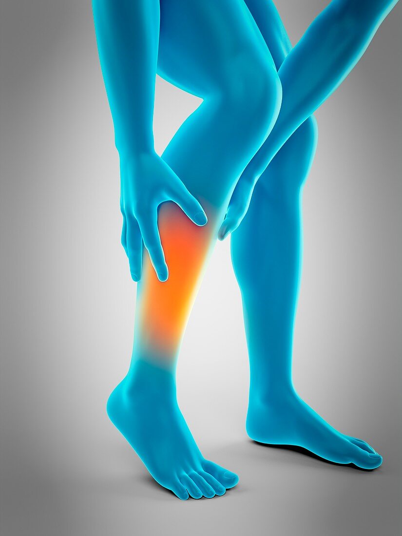 Human calf pain, illustration