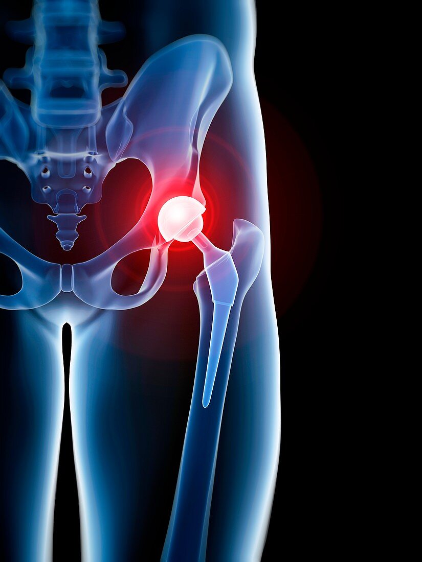 Human hip replacement, illustration