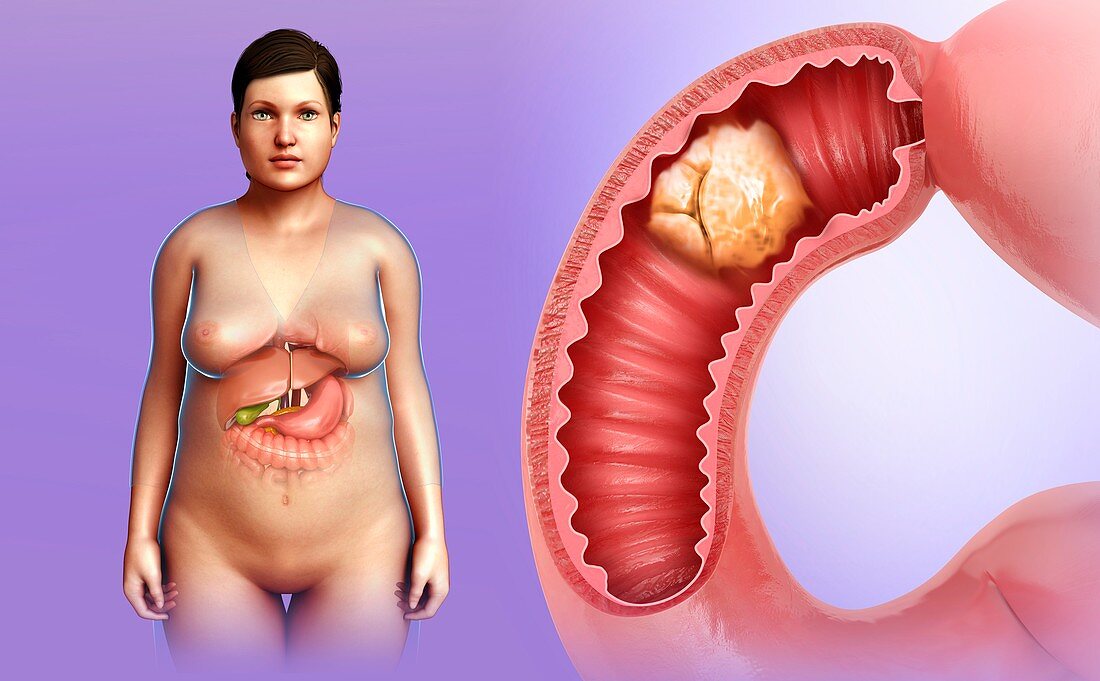 Female intestinal cancer, illustration