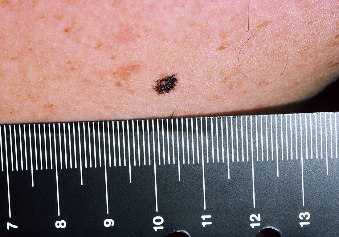 Lentigo: liver spot seen on the skin