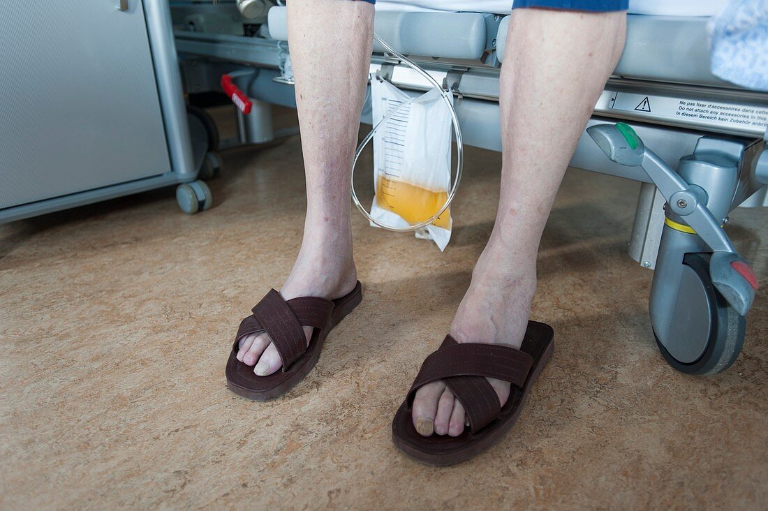 Male patient wearing sandals with urostomy bag