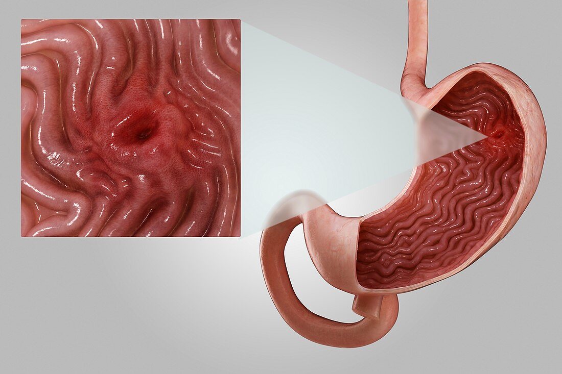 Gastric Ulcer, artwork