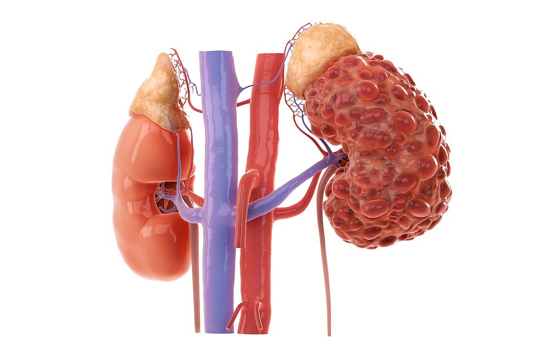 Polycystic Kidney, artwork