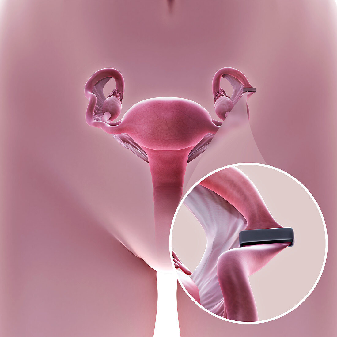 Tubal Ligation Clip , illustration