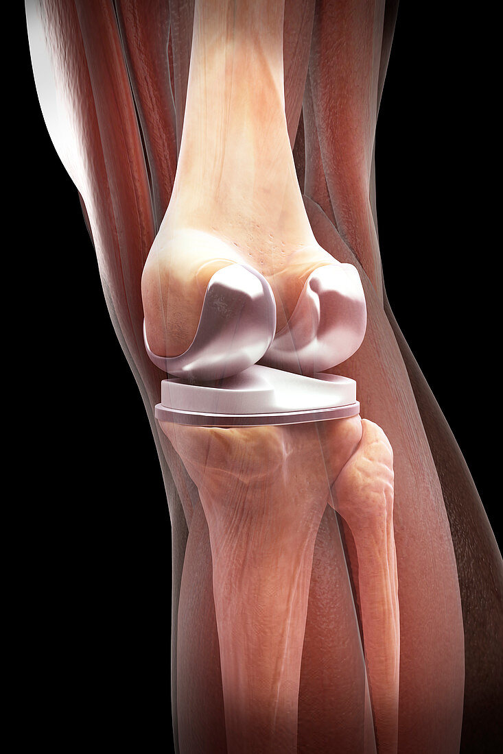 Knee Replacement, illustration