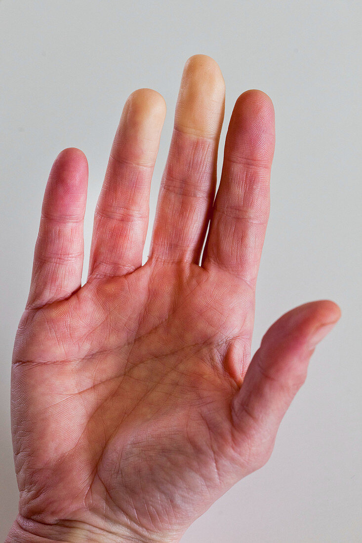 Raynaud's syndrome