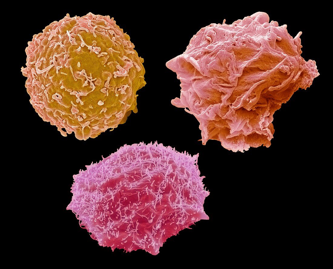 The common childhood cancers, SEM