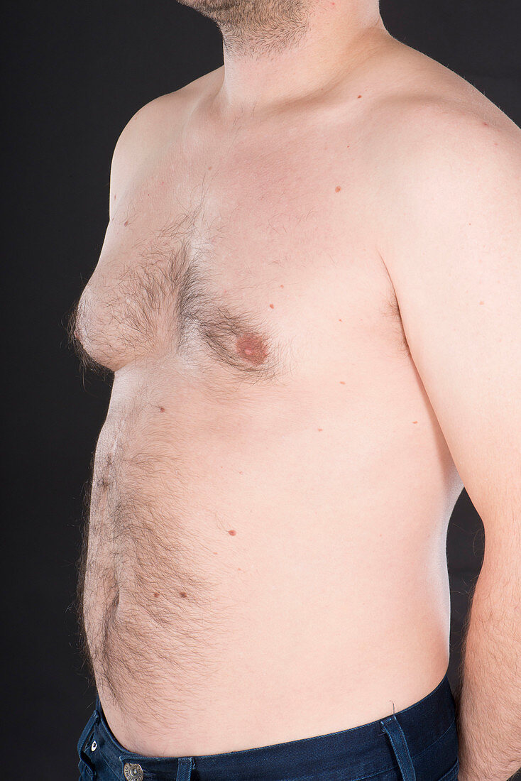 Enlarged male breast