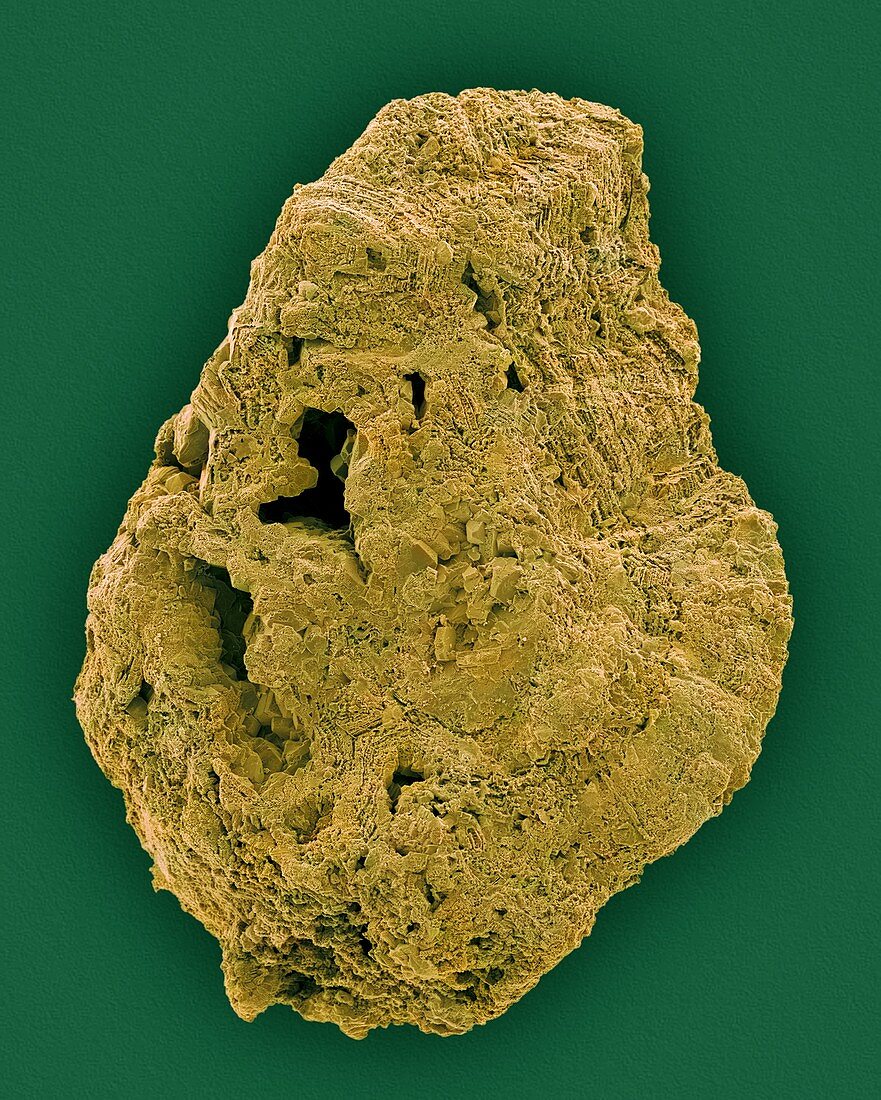 Kidney stone, SEM