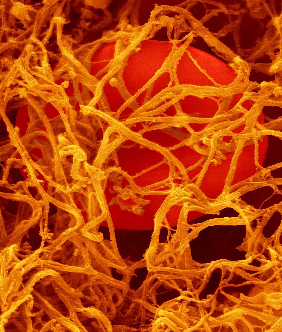 Red blood cells in a blood clot, SEM