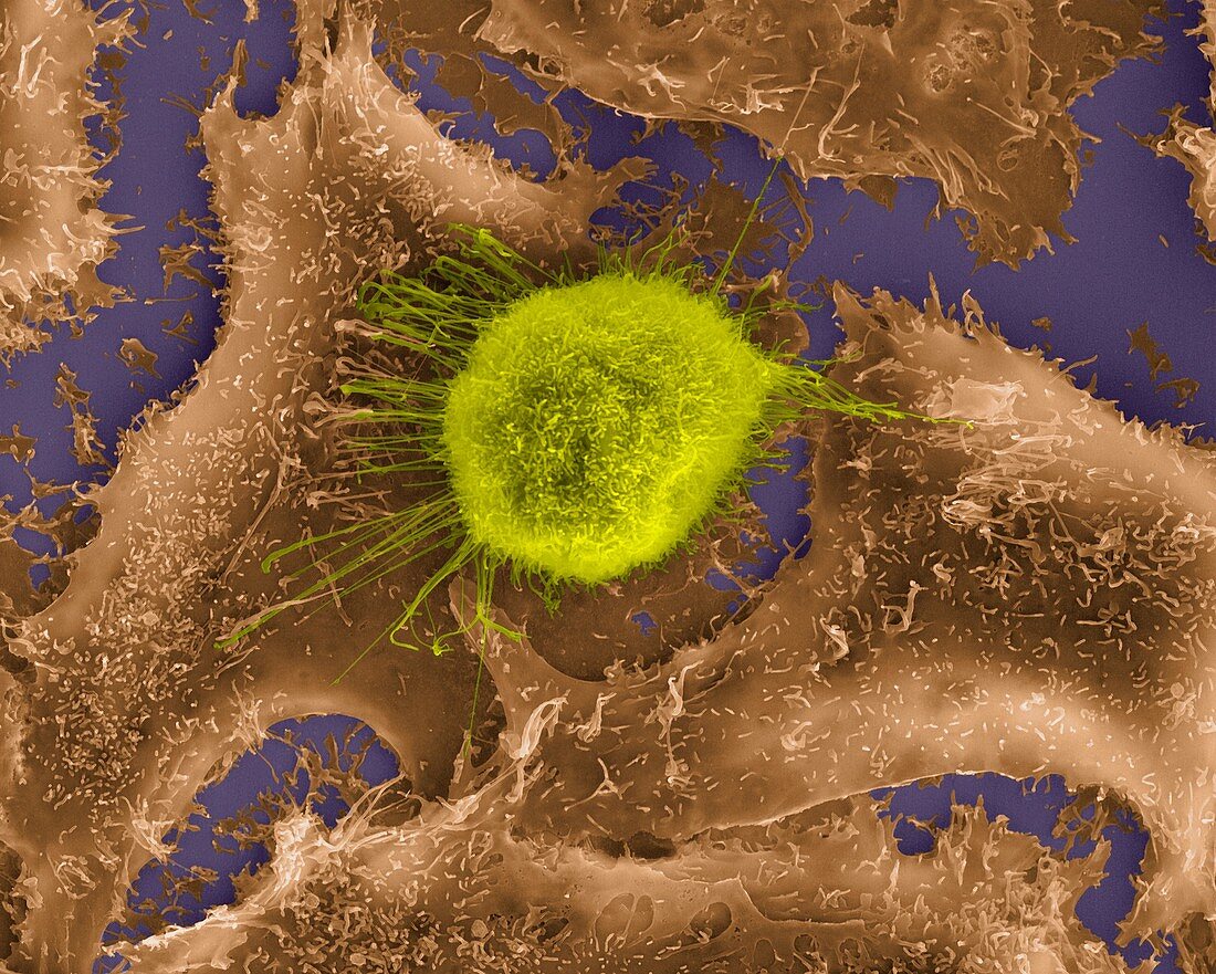 Lung epithelial cancer cell among healthy epithelia, SEM