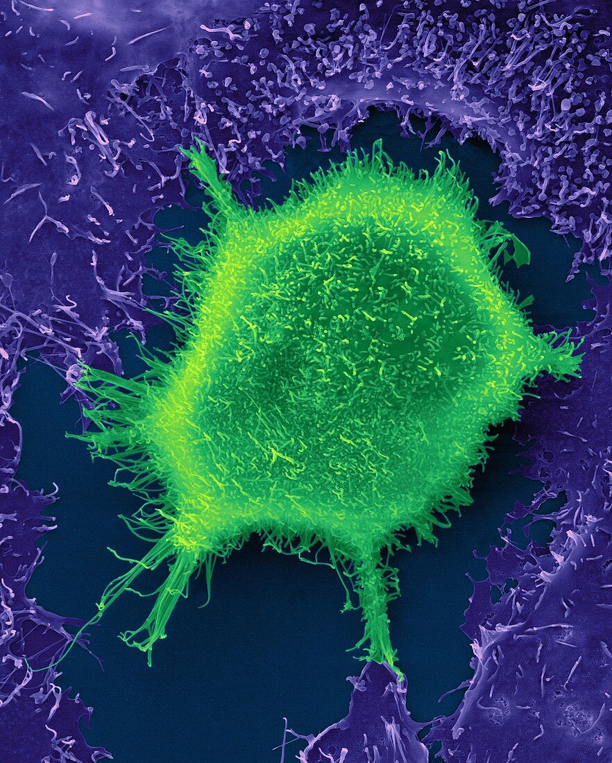 Lung epithelial cancer cell, SEM