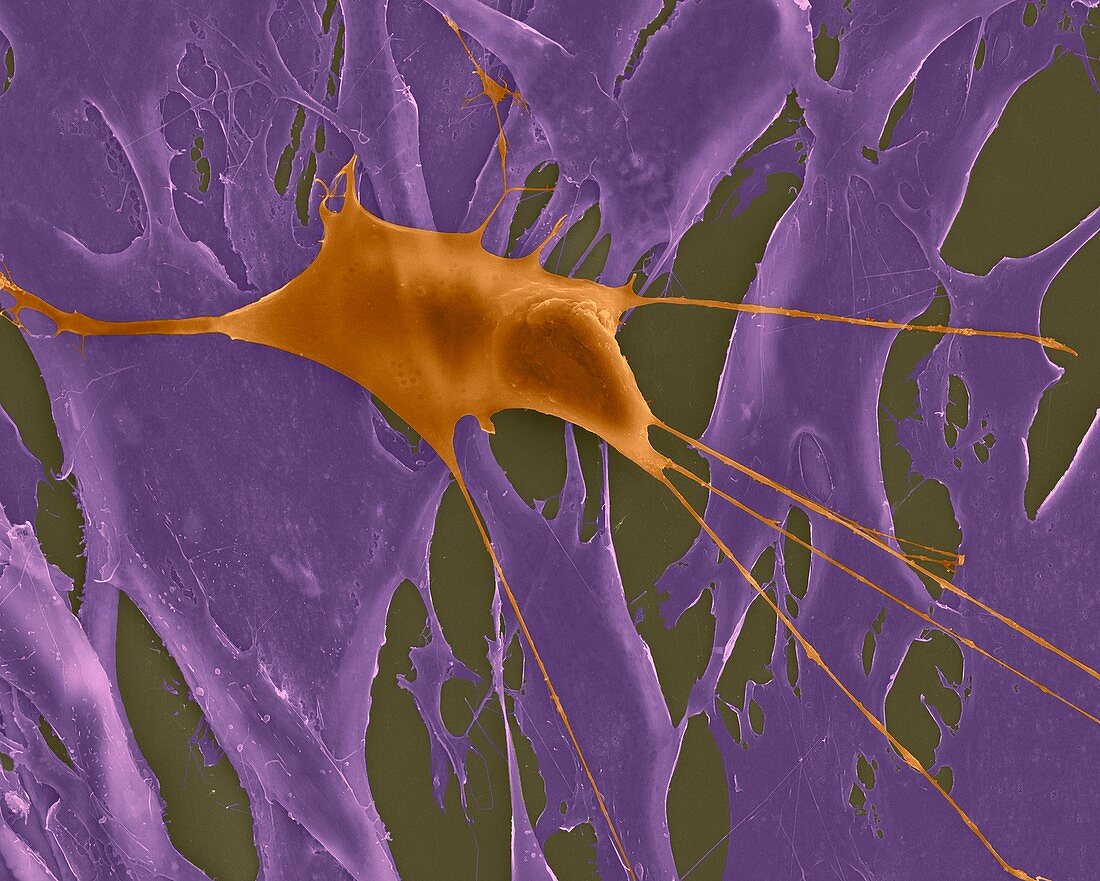 Lung fibroblast cancer cell among healthy fibroblasts, SEM