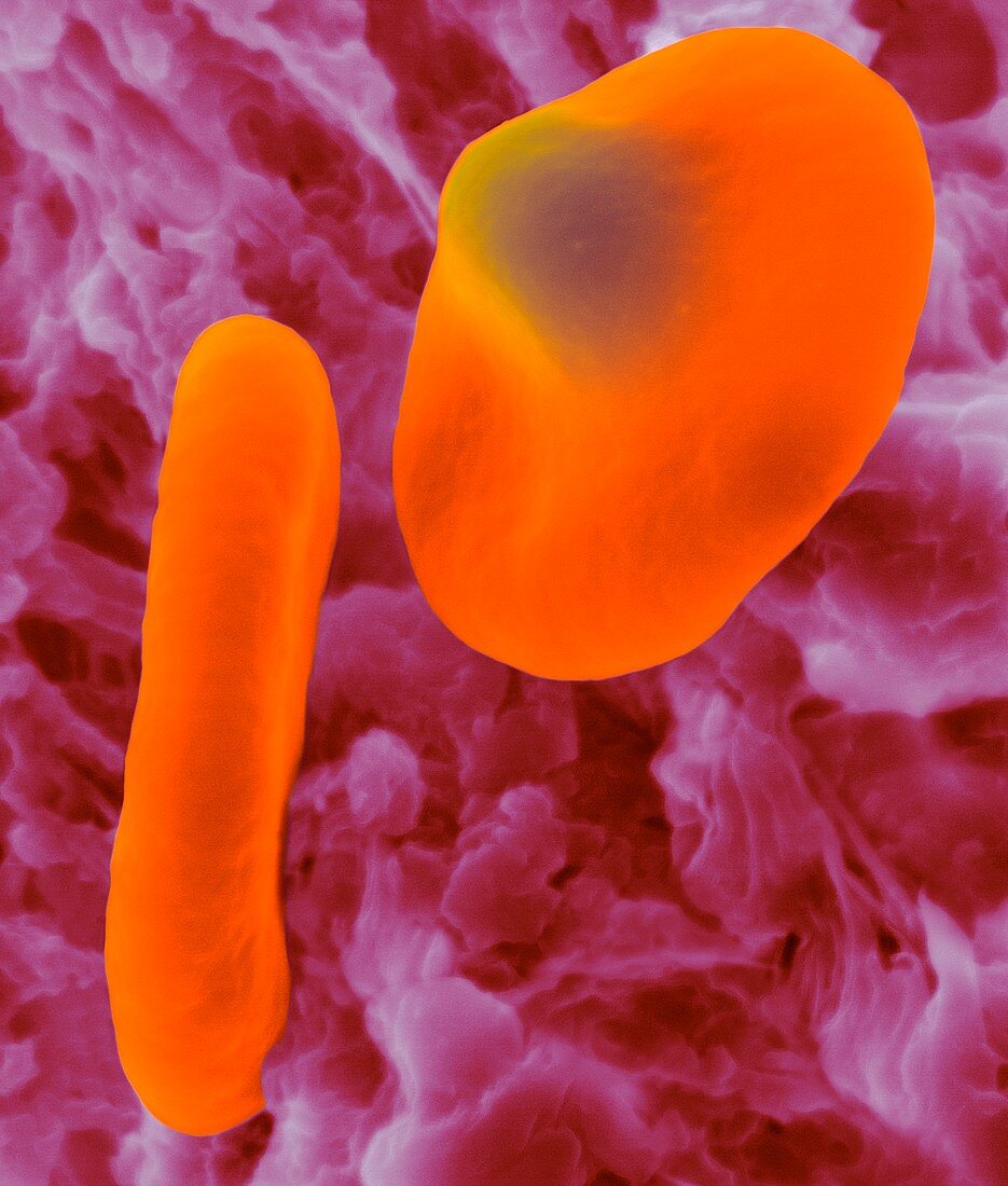 Red blood cell with the malaria parasite, SEM