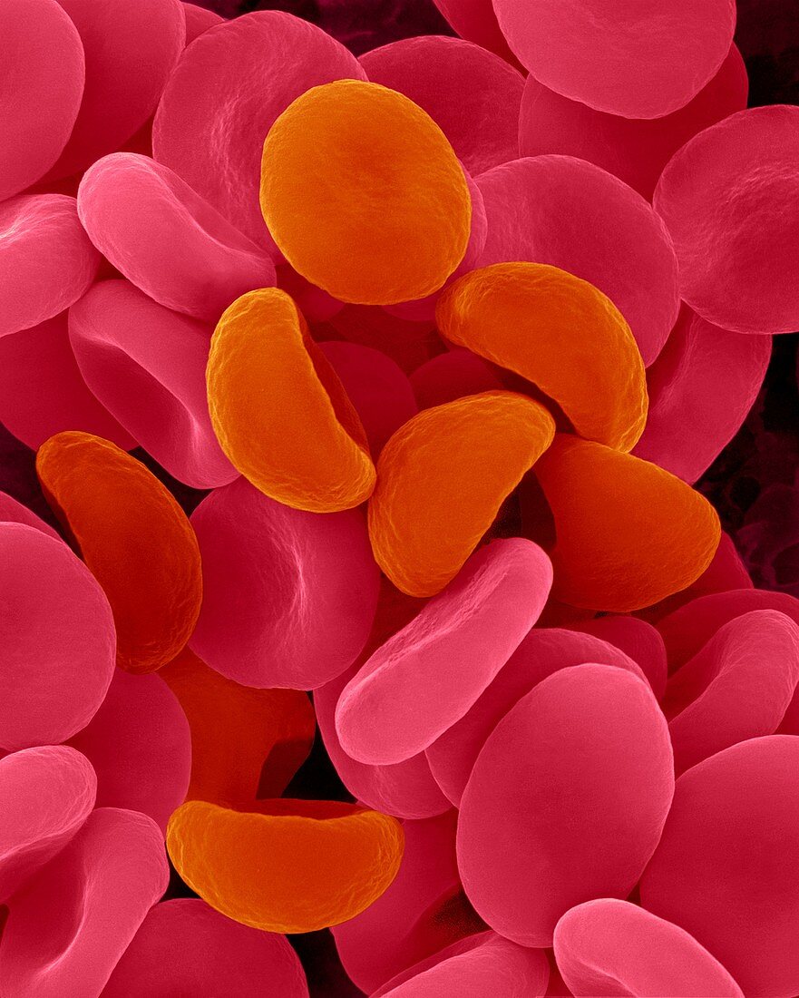 Red blood cells in hypotonic solution, SEM