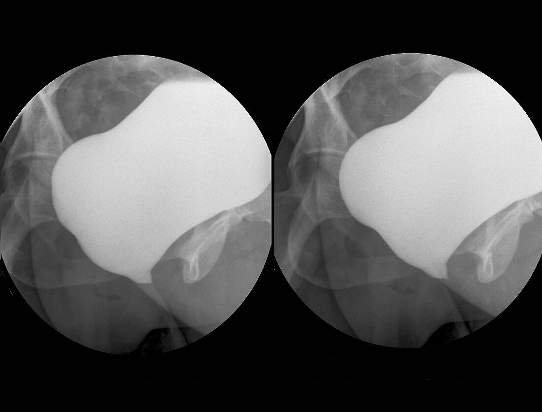 Urodynamic bladder test, retrograde cystography