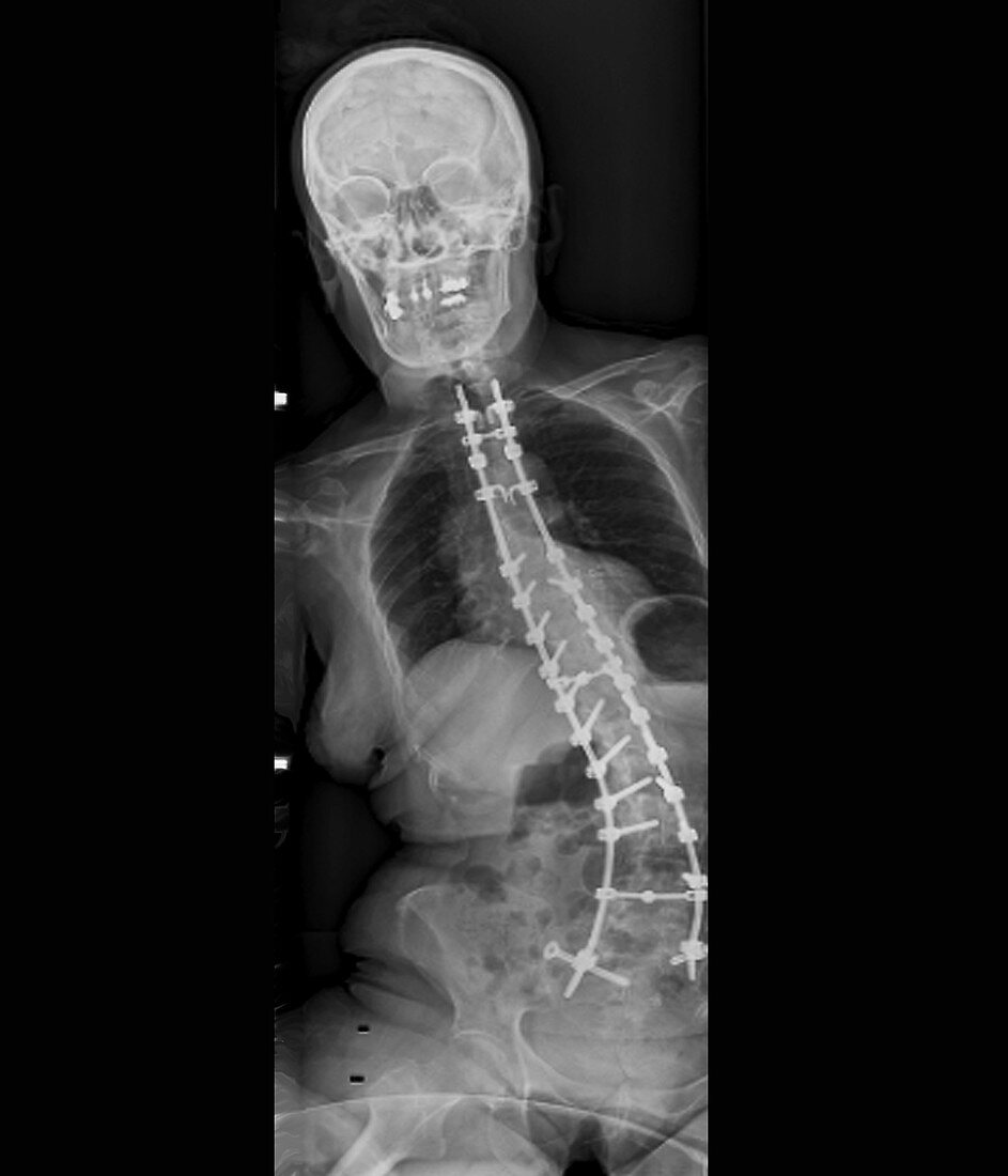 Spinal implants in scoliosis, X-ray