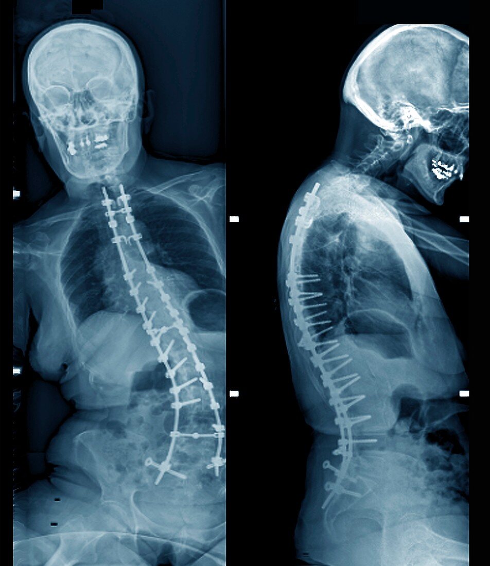 Spinal implants in scoliosis, X-rays