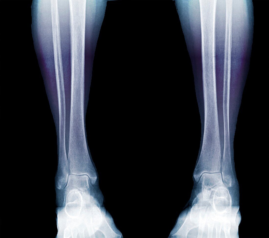 Bone demineralisation assessment, X-ray