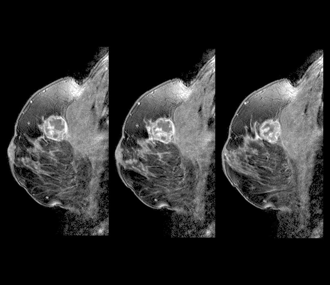 Breast cancer, MRI scans