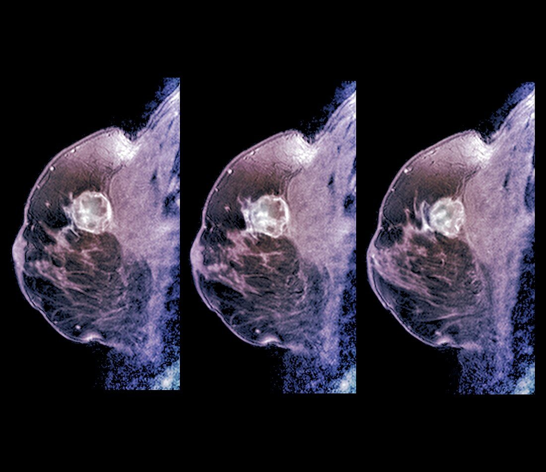 Breast cancer, MRI scans