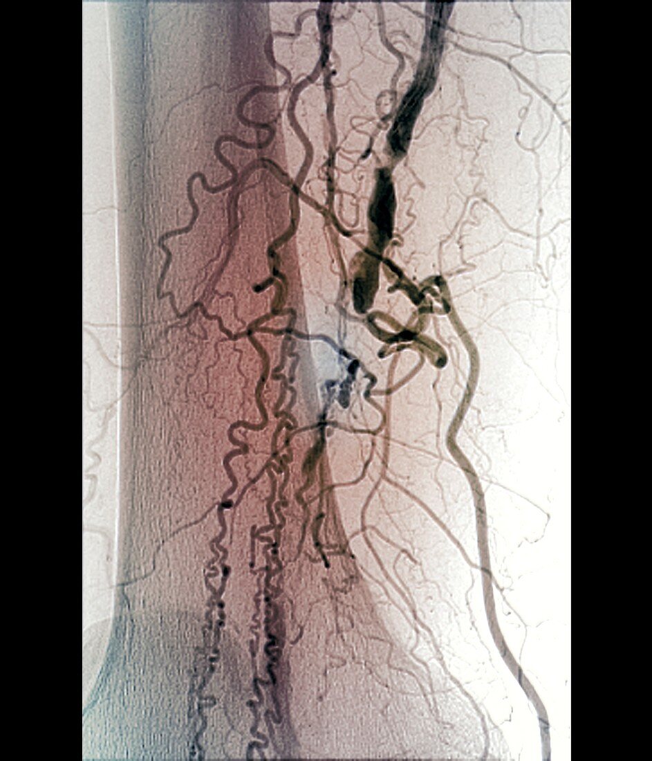 Blocked femoral artery, X-ray