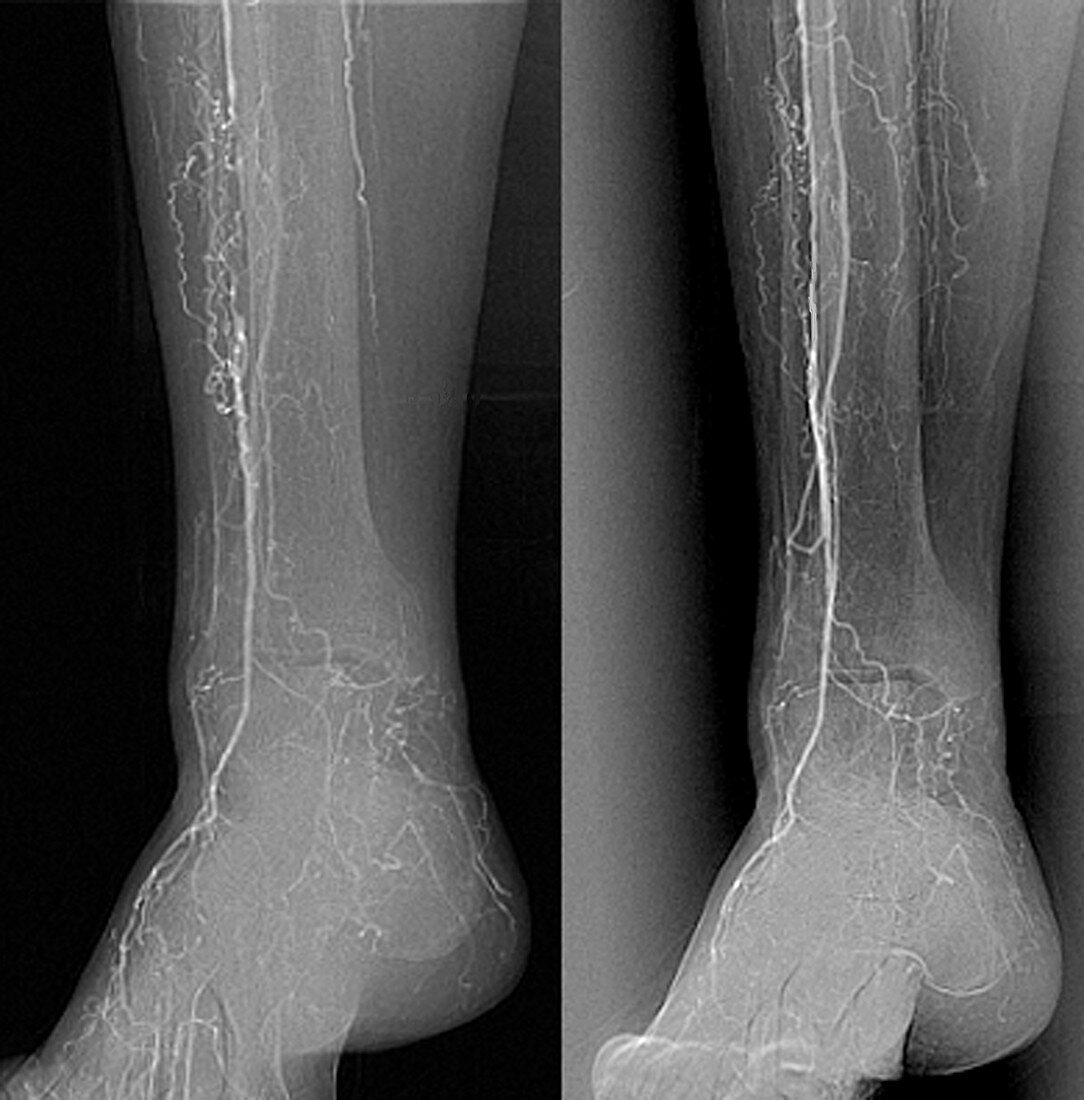 Treatment for blocked leg arteries, X-ray