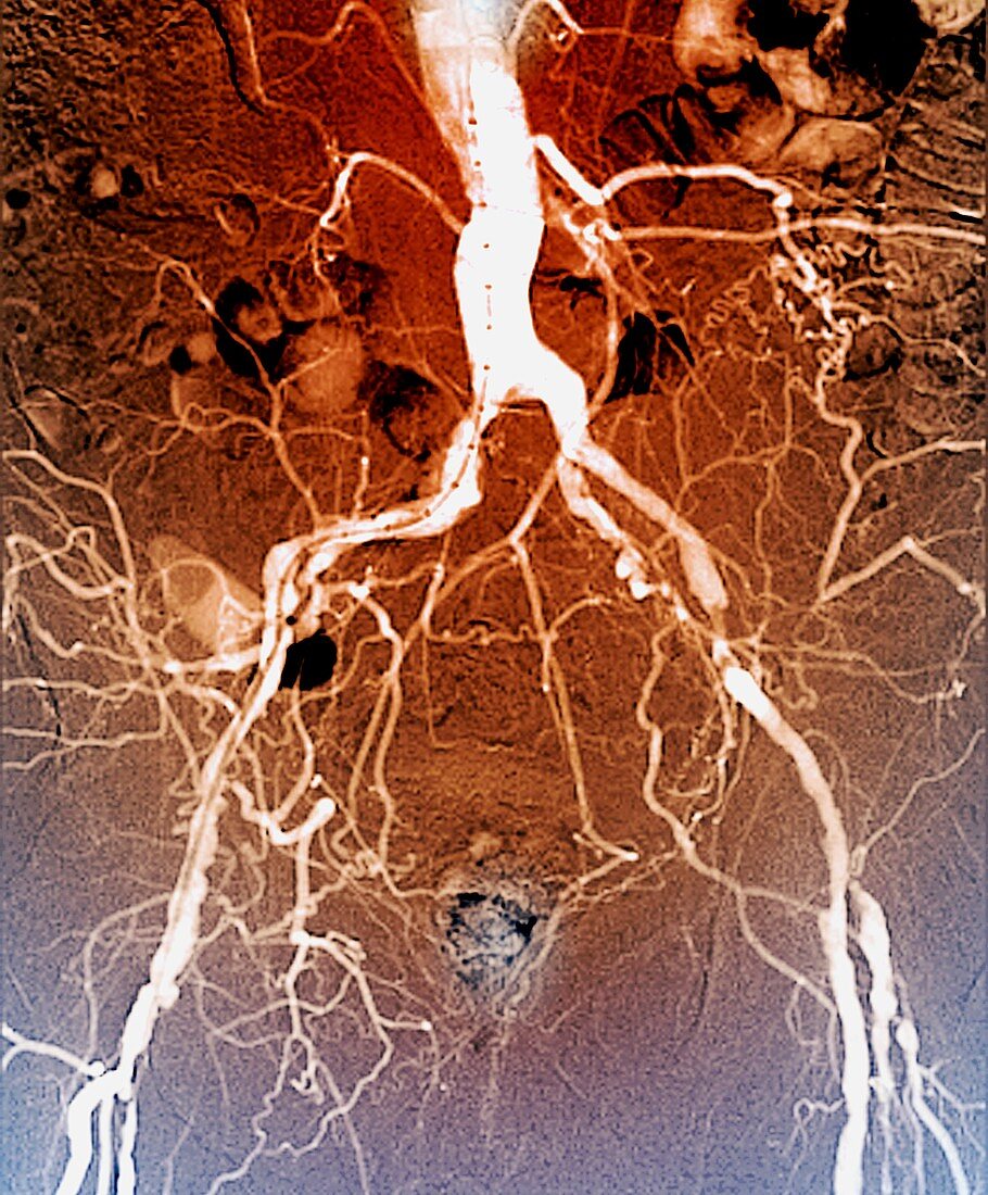 Narrowed iliac artery, X-ray