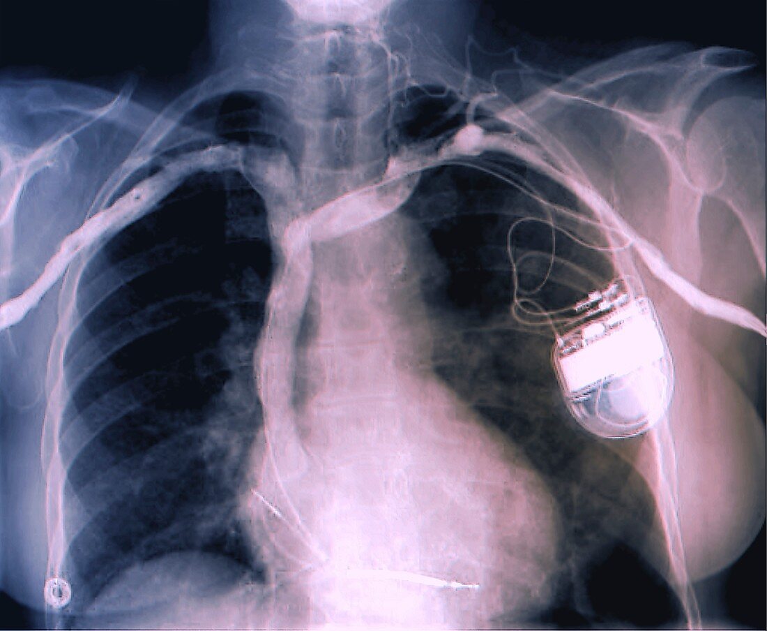 Cardiac pacemaker, chest X-ray