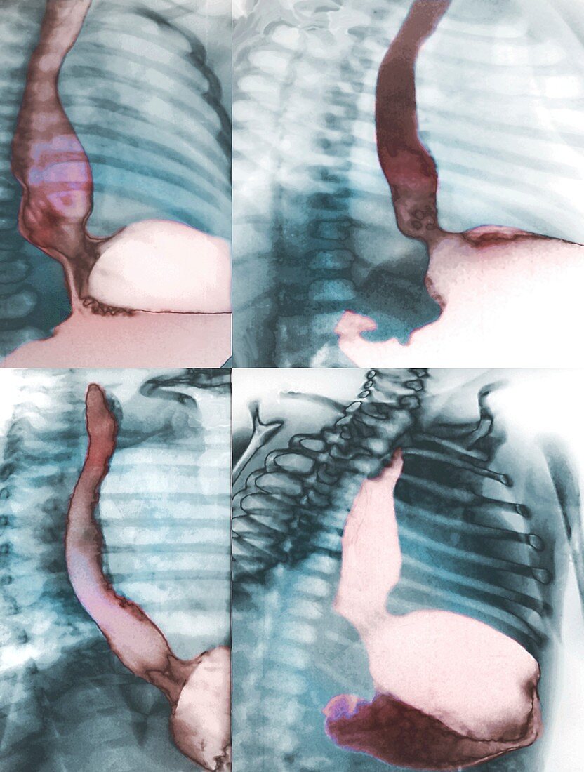 Oesophageal reflux, X-rays