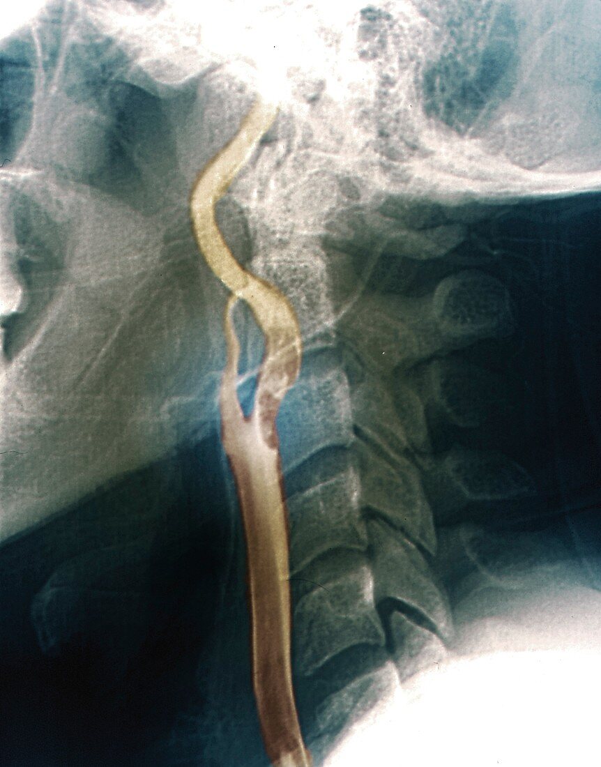 Thrombus in carotid artery, X-ray