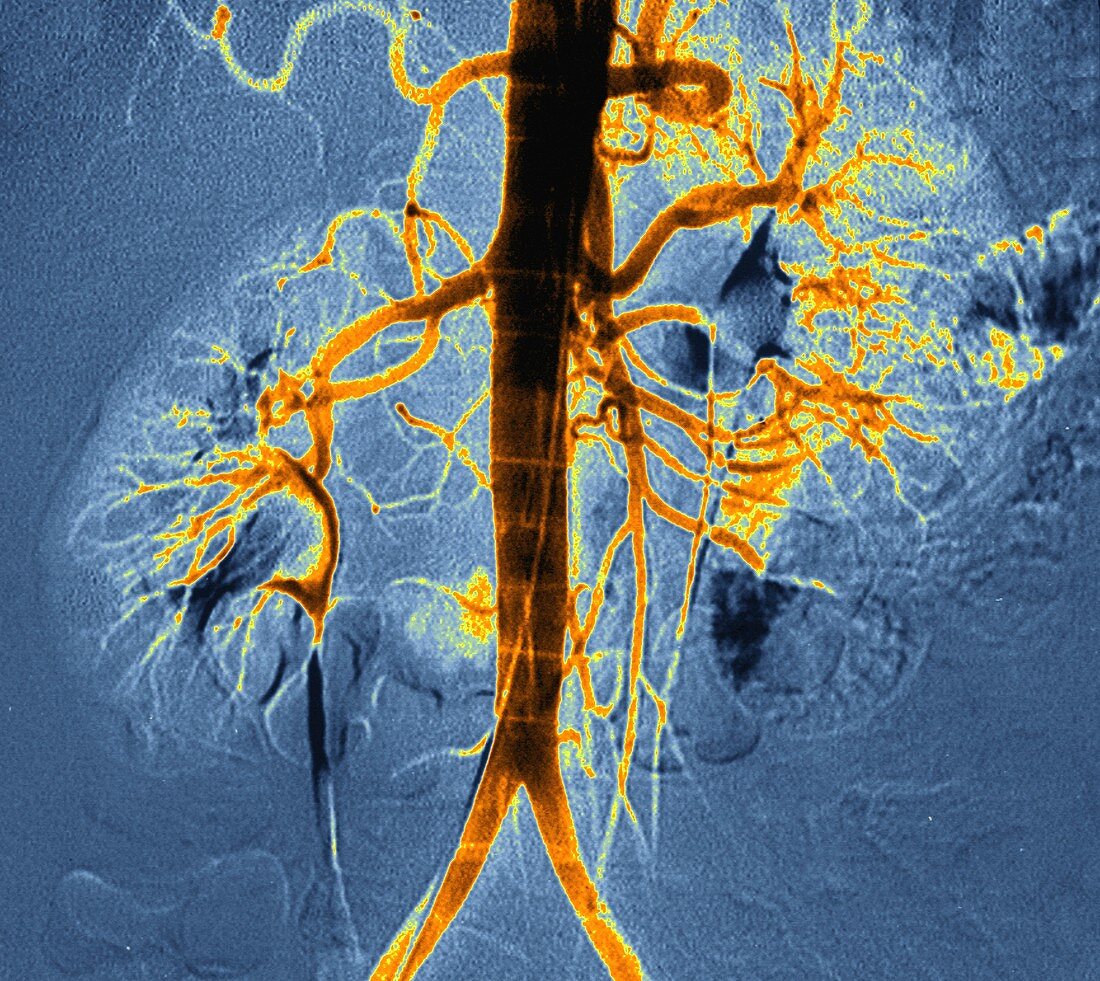 Kidney blood vessels, angiogram