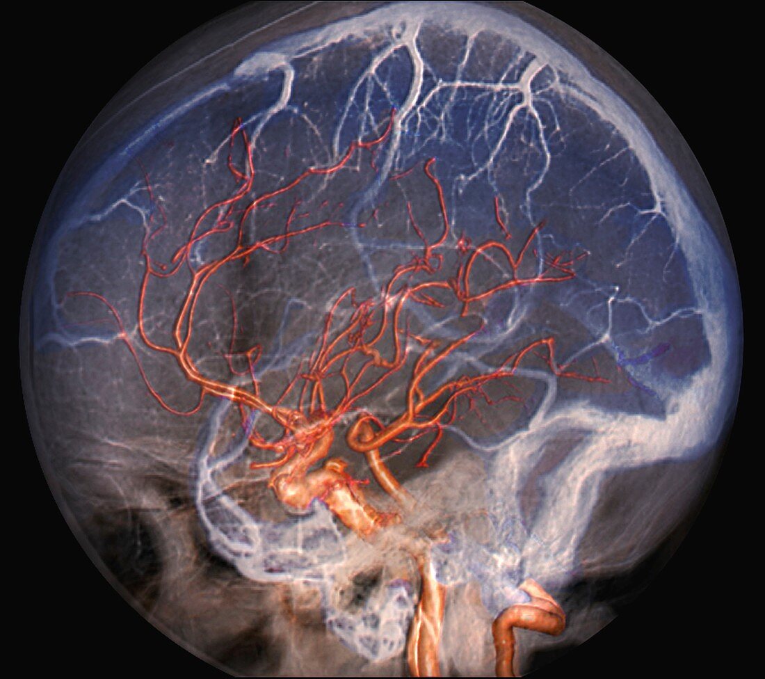 Brain blood vessels, 3D CT scan