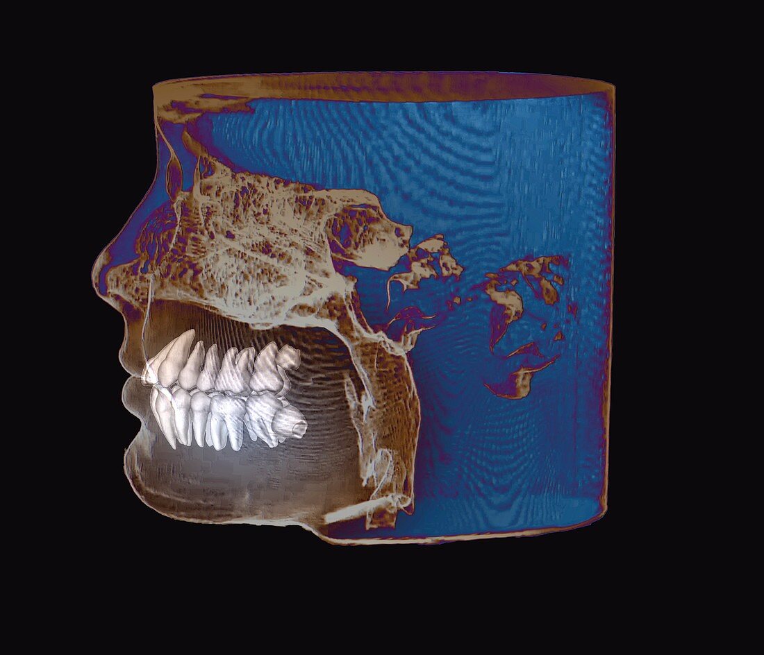 Inclined wisdom teeth, 3D cone CT scan