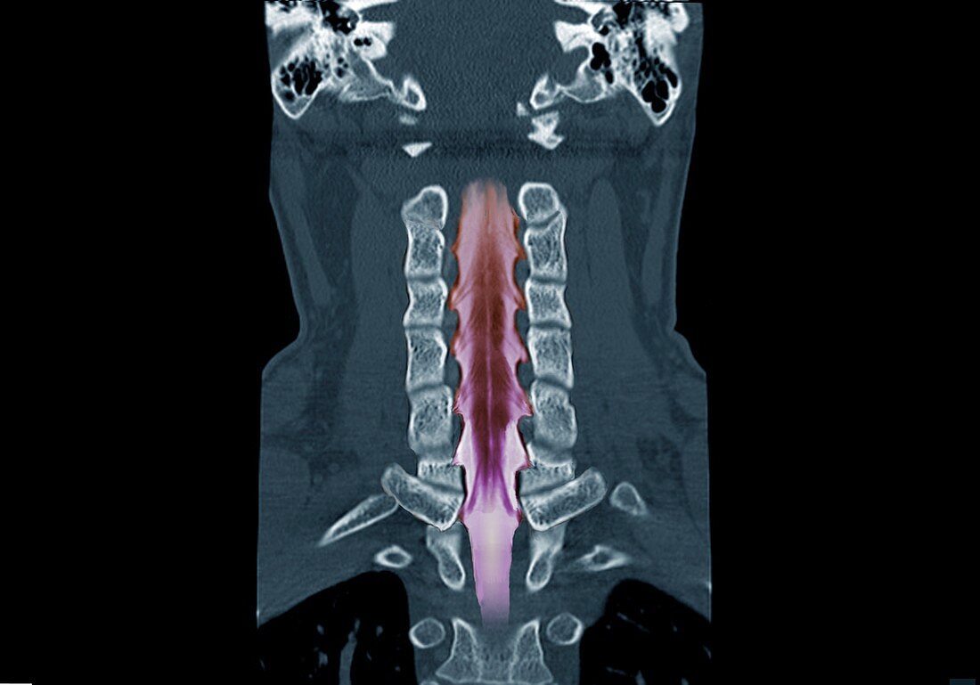 Neck bones and spinal cord, CT scan