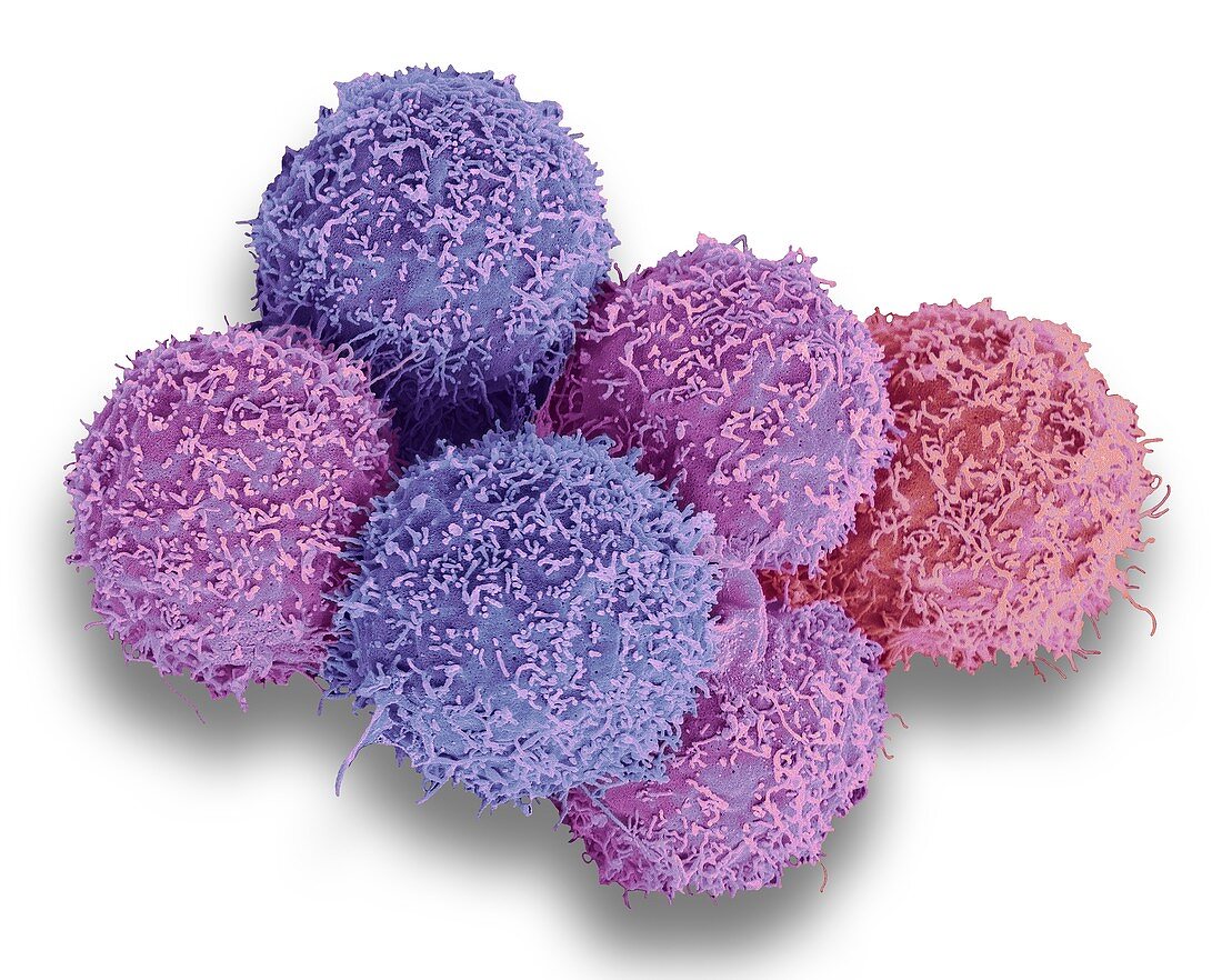Bladder cancer cells, SEM
